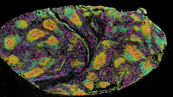 Spatial transcriptomics of thyroid tissue from a donor with autoimmune thyroid disease